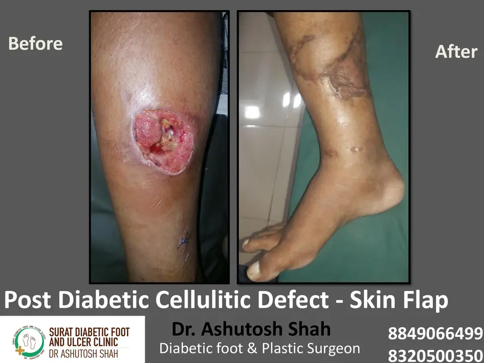 Diabetic Cellulitis and Coverage.pptx-2.webp